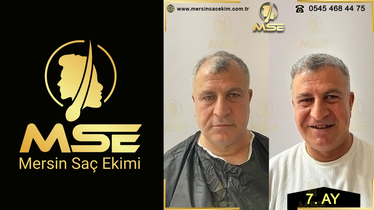 Mersin Saç Ekimi